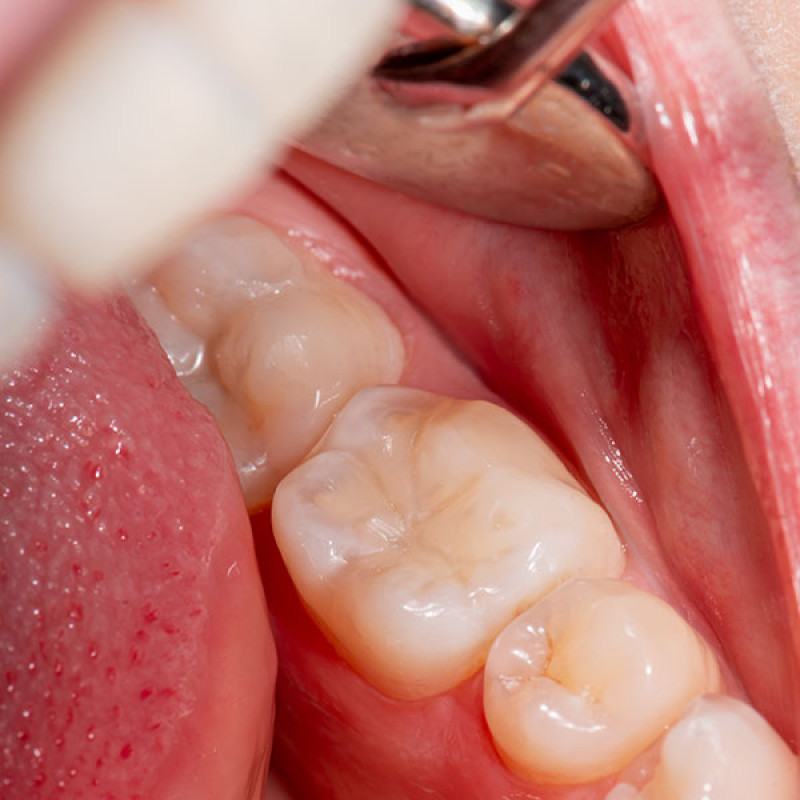 Dental Fillings