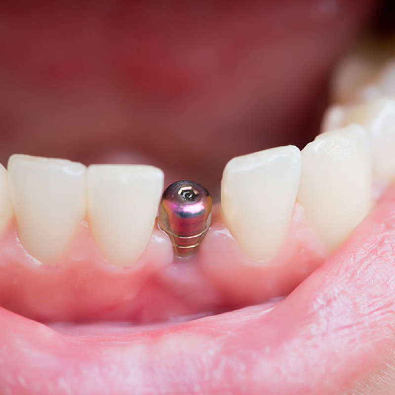 Dental Implant